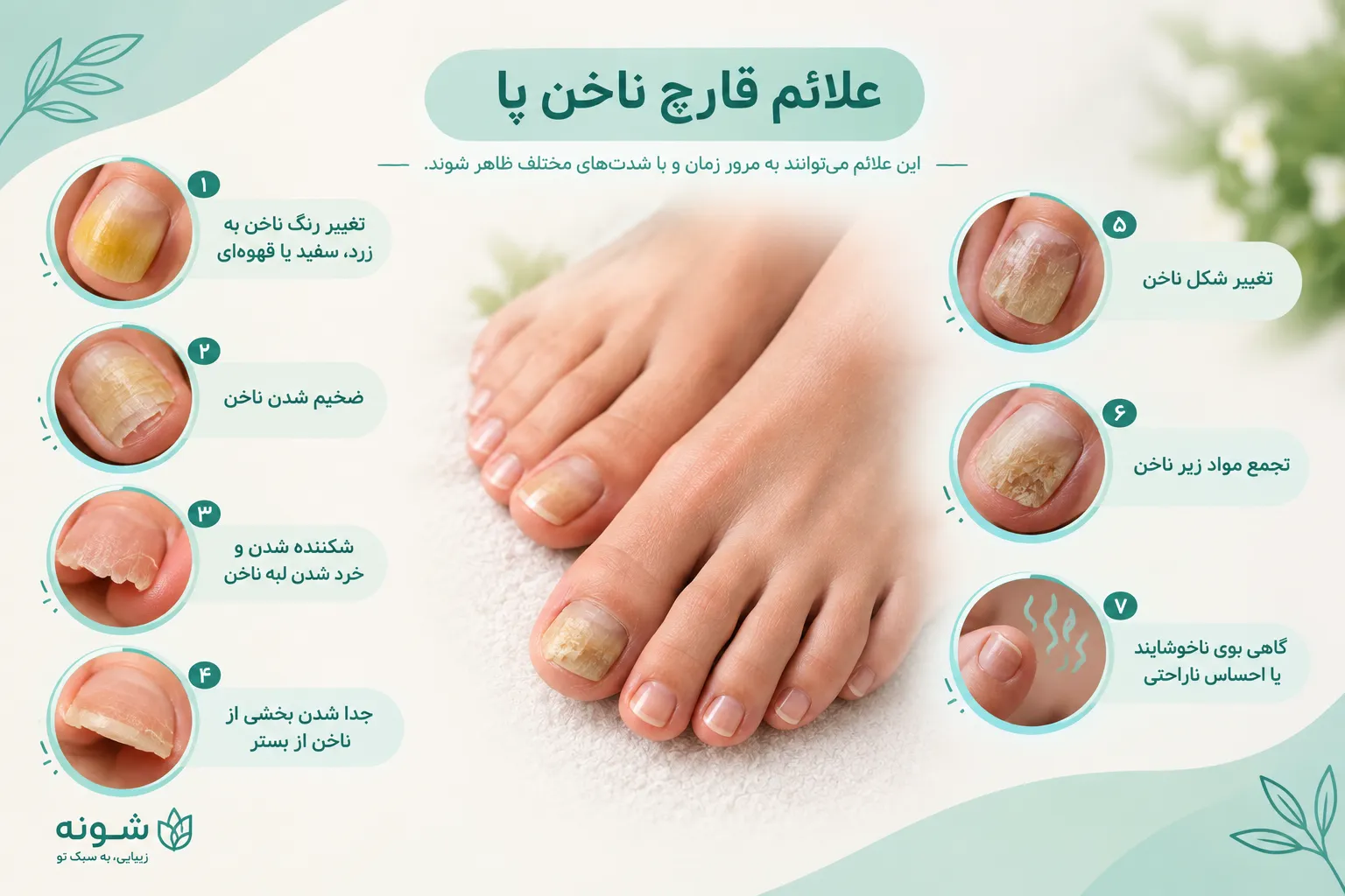 قارچ ناخن