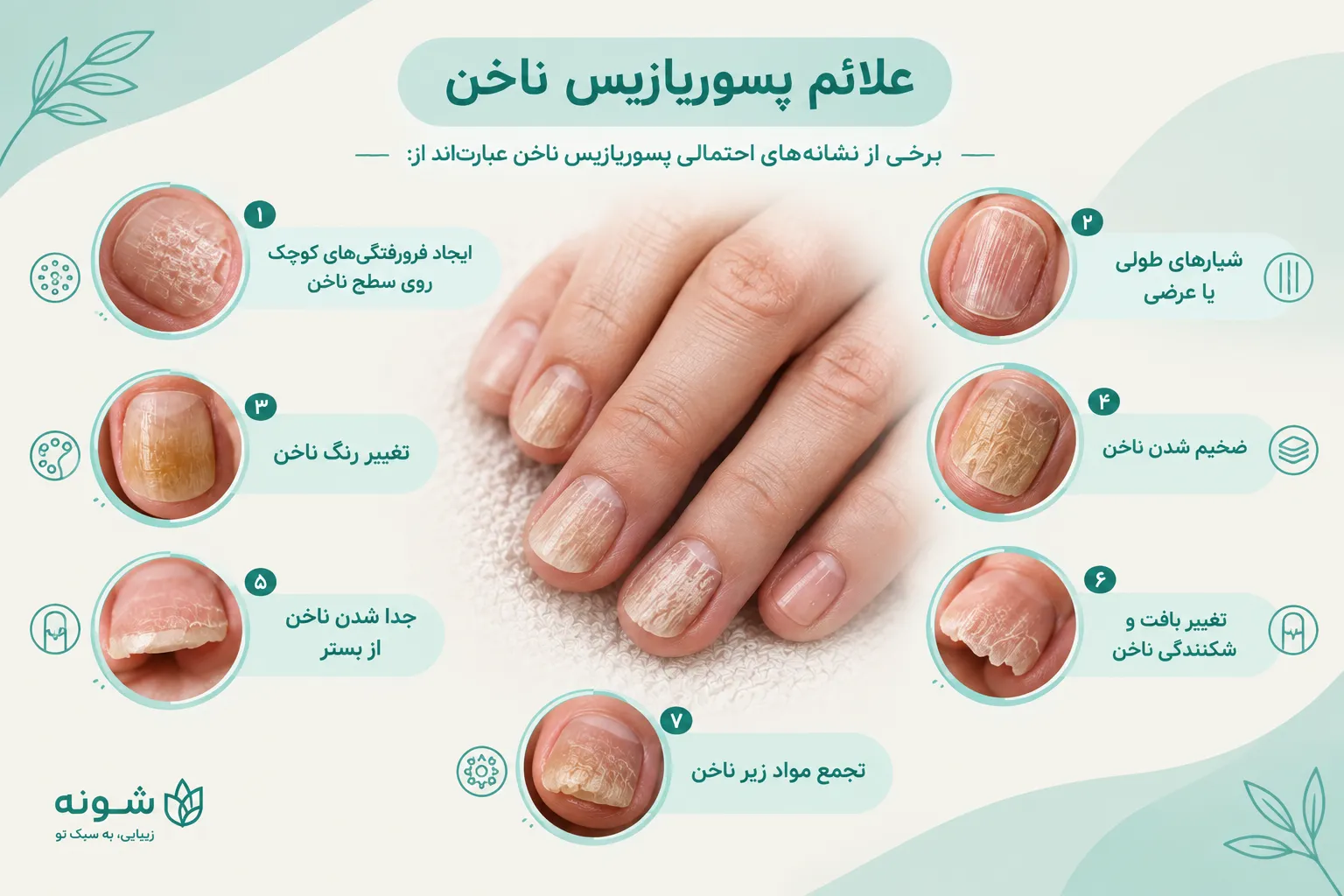 پسوریازیس ناخن
